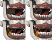 3D computer model of four images of a mouth chewing a piece of chocolate