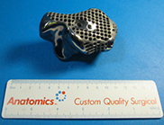 Titanium ankle bone implant laid next to a ruler to indicate size.