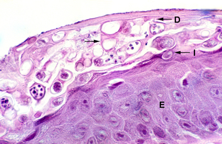 Histological section of infected skin with various stages of the amphibian chytrid present in the outer epidermal layers